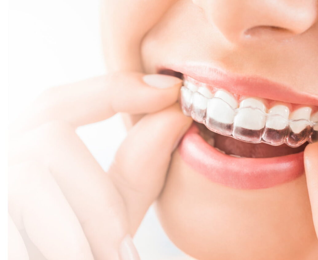 invisalign clear