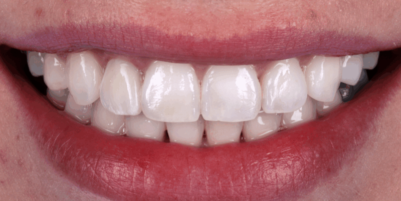 WhiteningCrown2