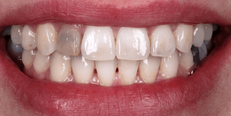 Whiteningcrown1